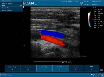 EDAN U50