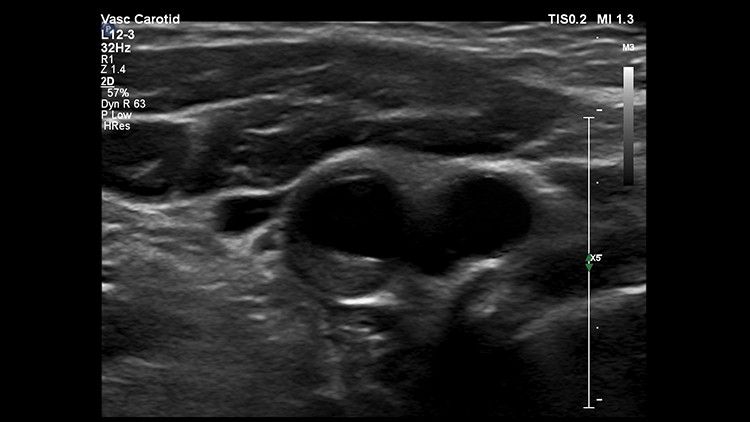 Philips EPIQ CVx