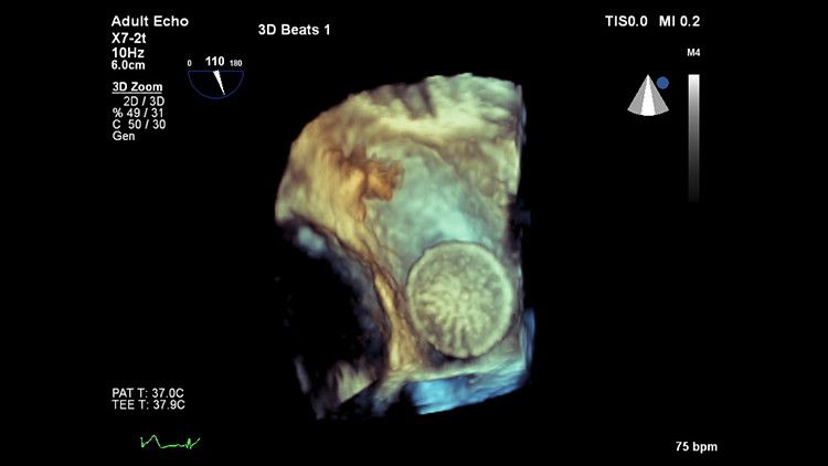 Philips EPIQ CVx